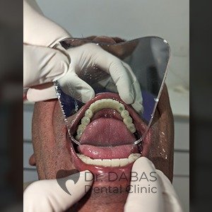Dental Implants Post Op
