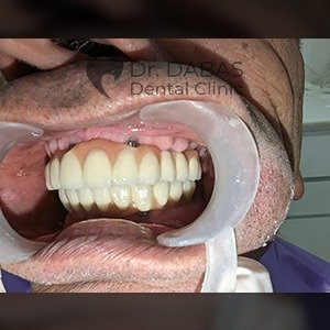 Dental Implants Pre Op