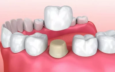 dental_crowns-1024x536-1